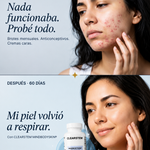 Tratamiento para Acné Hormonal -Recupera tu confianza ✨